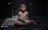 Illustrative: Ahmed El-Sheikh Eid, 7,  who shows signs of malnutrition, poses for a photo at his family tent at a camp for displaced Palestinians in al-Mawasi, near Khan Younis in the southern Gaza Strip, May 2, 2025. (AP Photo/Abdel Kareem Hana)