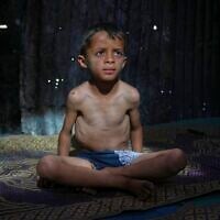 Illustrative: Ahmed El-Sheikh Eid, 7,  who shows signs of malnutrition, poses for a photo at his family tent at a camp for displaced Palestinians in al-Mawasi, near Khan Younis in the southern Gaza Strip, May 2, 2025. (AP Photo/Abdel Kareem Hana)