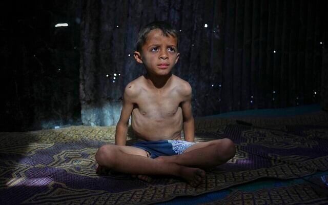 Illustrative: Ahmed El-Sheikh Eid, 7,  who shows signs of malnutrition, poses for a photo at his family tent at a camp for displaced Palestinians in al-Mawasi, near Khan Younis in the southern Gaza Strip, May 2, 2025. (AP Photo/Abdel Kareem Hana)
