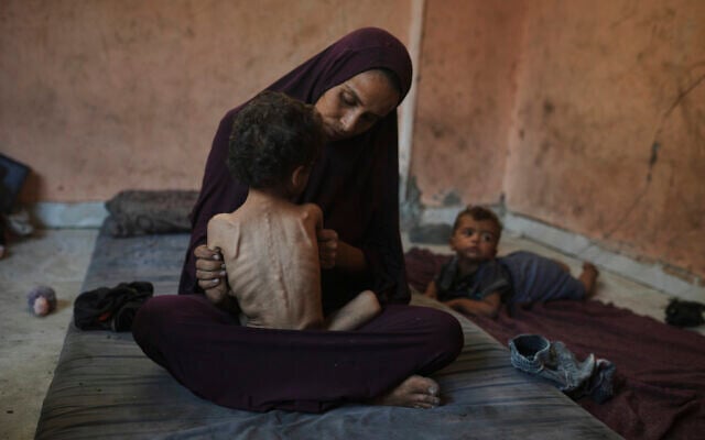Naima Abu Ful holds her malnourished 2-year-old child, Yazan, at their home in the Shati refugee camp in Gaza City on July 23, 2025. (AP Photo/Jehad Alshrafi) Naima Abu Ful holds her malnourished 2-year-old child, Yazan, at their home in the Shati refugee camp in Gaza City on July 23, 2025. (AP Photo/Jehad Alshrafi)