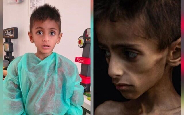 5-year-old Osama al-Rakab is seen receiving medical treatment, left. COGAT says a viral image of him, right, was used to falsely accuse Israel of starving children in Gaza. (Screen capture: COGAT via X)