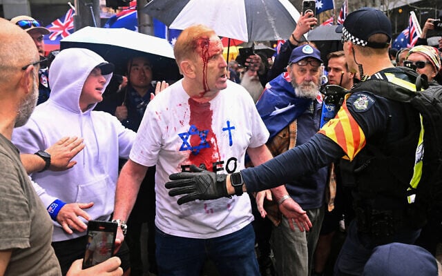 An injured protester reacts during a March for Australia anti-immigration rally in Melbourne on August 31, 2025. (William WEST / AFP)