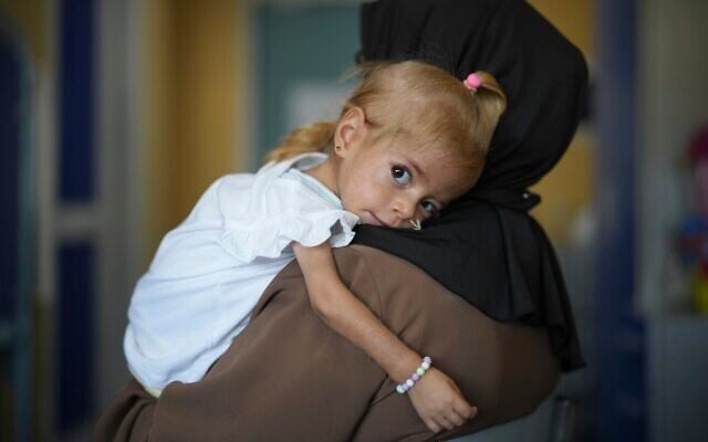 Islam Qudeih holds her daughter, Shamm Qudeih, 2, during an interview with The Associated Press at the Santobono Pausilipon Children's Hospital in Naples, southern Italy, Tuesday, Sept. 2, 2025, where Shamm is being treated after being evacuated from Gaza. (AP Photo/Andrew Medichini) Islam Qudeih holds her daughter, Shamm Qudeih, 2, during an interview with The Associated Press at the Santobono Pausilipon Children's Hospital in Naples, southern Italy, Tuesday, Sept. 2, 2025, where Shamm is being treated after being evacuated from Gaza. (AP Photo/Andrew Medichini)