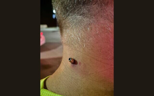 A 5.6 caliber bullet can be seen lodged in the back of the neck of Amiram Dvir, in an image circulated on social media, on October 27, 2025. (X; used in accordance with Clause 27a of the Copyright Law) A 5.6 caliber bullet can be seen lodged in the back of the neck of Amiram Dvir, in an image circulated on social media, on October 27, 2025. (X; used in accordance with Clause 27a of the Copyright Law)