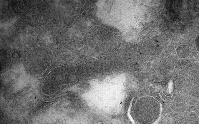 A bacterial cell (elongated shape in the center) inside a glioblastoma tumor cell, as seen through an electron microscope. The black dots within the bacterium are engineered antibodies carrying gold particles that bind specifically to a component found only in bacterial cell envelopes and not in human cells. (Courtesy/Weizmann Institute of Science) A bacterial cell (elongated shape in the center) inside a glioblastoma tumor cell, as seen through an electron microscope. The black dots within the bacterium are engineered antibodies carrying gold particles that bind specifically to a component found only in bacterial cell envelopes and not in human cells. (Courtesy/Weizmann Institute of Science)