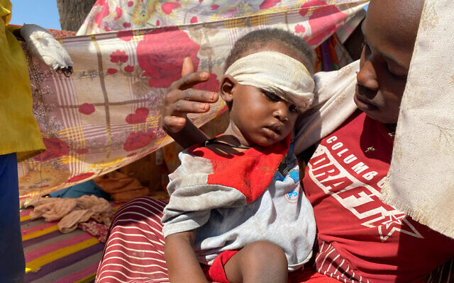 A Sudanese child who fled el-Fasher city with family after Sudan's paramilitary forces killed hundreds of people in the western Darfur region, receives treatment at a camp in Tawila, Sudan, November 2, 2025. (Mohammed Abaker/AP) A Sudanese child who fled el-Fasher city with family after Sudan's paramilitary forces killed hundreds of people in the western Darfur region, receives treatment at a camp in Tawila, Sudan, November 2, 2025. (Mohammed Abaker/AP)