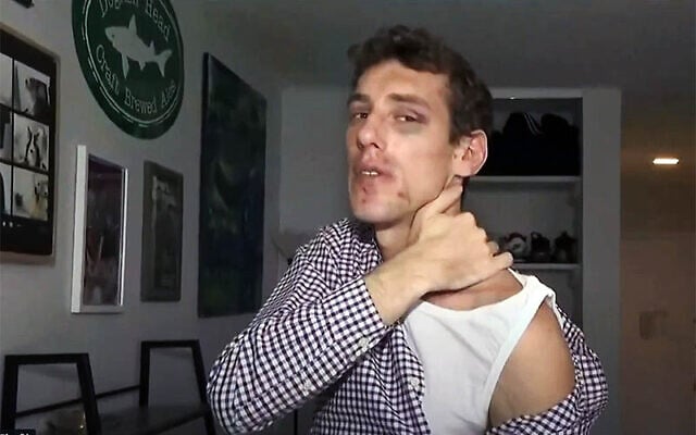 Joey Borgen shows his injuries after being beat by a pro-Palestinian mob in the streets of New York. (video screenshot) Joey Borgen shows his injuries after being beat by a pro-Palestinian mob in the streets of New York. (video screenshot)