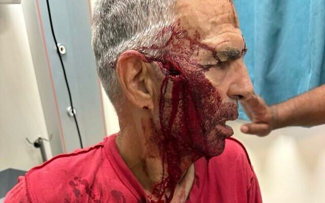 Oded Yedaya is treated after being attacked by settlers while assisting Palestinians during the olive harvest in Beita on November 7, 2025. (Courtesy) Oded Yedaya is treated after being attacked by settlers while assisting Palestinians during the olive harvest in Beita on November 7, 2025. (Courtesy)