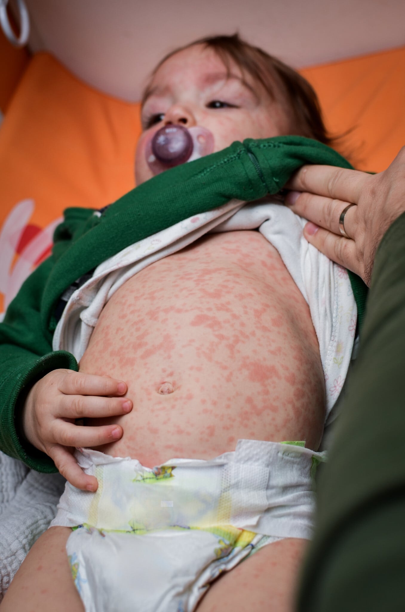 Year-old child dies of measles in Jerusalem, in 14th fatality of outbreak