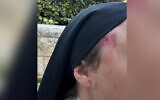 Bruising on the face of a nun following an assault in Jerusalem, April 29, 2026. (Israel Police)