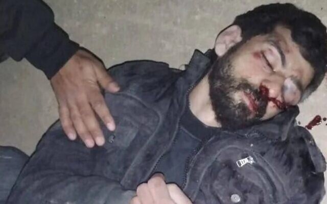 Zahran Shanabla, who was allegedly injured by settlers near his workplace in the village of Qusra, south of Nablus, April 4, 2026, and was still in a coma as of May 3, 2026. (used in accordance with Clause 27a of the Copyright Law) Zahran Shanabla, who was allegedly injured by settlers near his workplace in the village of Qusra, south of Nablus, April 4, 2026, and was still in a coma as of May 3, 2026. (used in accordance with Clause 27a of the Copyright Law)