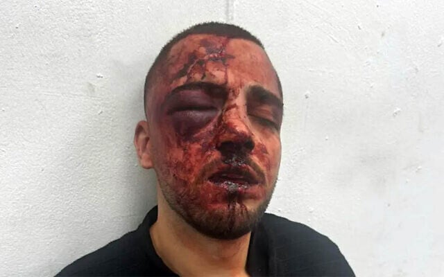 Salah Khalil Faisal Na'ameh, an Arab Israeli prosecutor in the Southern District Attorney's Office, is seen after he was attacked by police officers during arrest in Beersheba on May 1, 2026. (Used in accordance with Clause 27a of the Copyright Law)