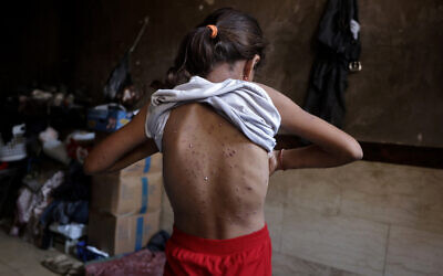 A displaced Palestinian girl, who according to doctors is suffering from chickenpox, shows rashes on her back as she stands inside her family’s tent in Khan Younis, in the southern Gaza Strip, on July 19, 2026. (Bashar Taleb/AFP) A displaced Palestinian girl, who according to doctors is suffering from chickenpox, shows rashes on her back as she stands inside her family’s tent in Khan Younis, in the southern Gaza Strip, on July 19, 2026. (Bashar Taleb/AFP)
