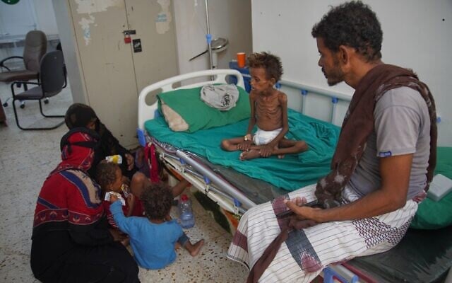 Mohammed al-Salami, displaced with his family from the city of Mokha, sits beside his son Tarek, 7, who is showing symptoms of malnutrition and receiving treatment as other family members sit nearby at a therapeutic feeding center in Buraiqa, on the western outskirts of Aden, Yemen, September 22, 2026. (AP Photo/Abdulnasser Alseddik)